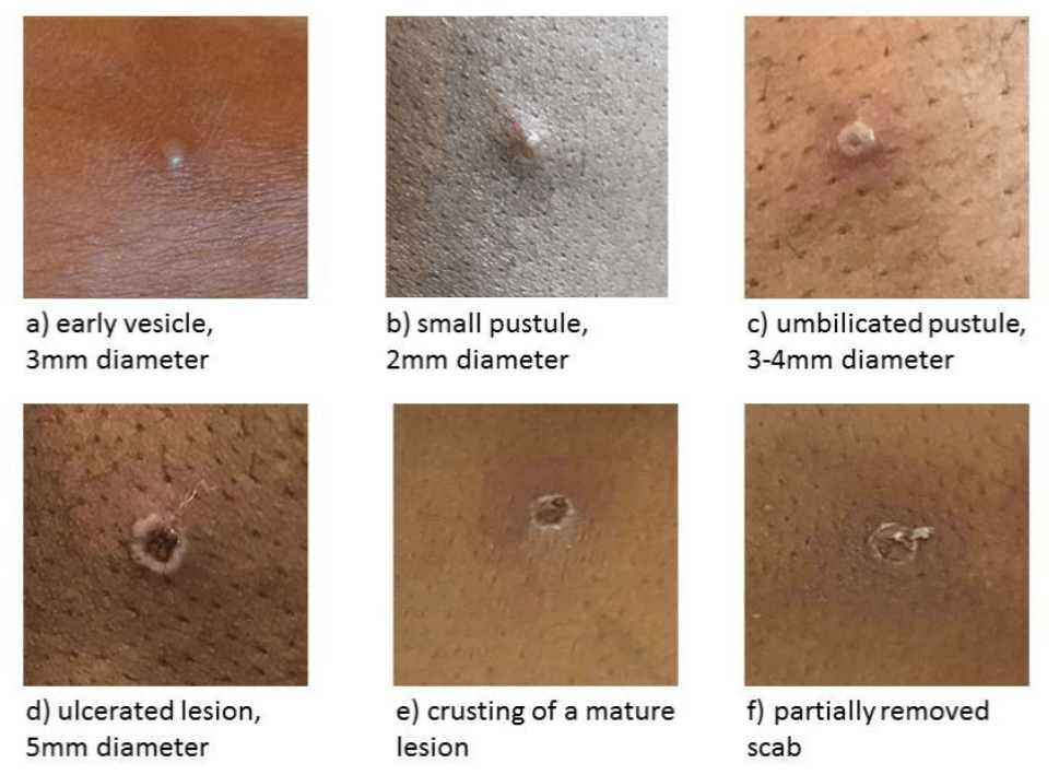 Інформаційний лист щодо реєстрації спалаху віспи мавп в країнах світу
